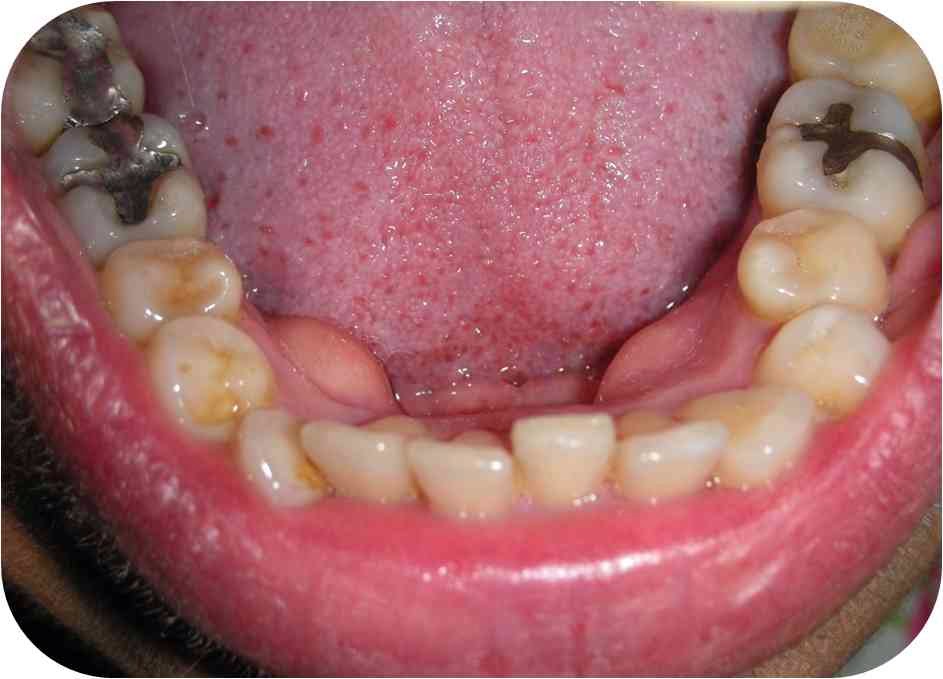 torus lingual etiologia diabetes torus lingual etiologia diabetes